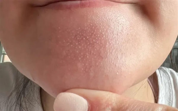 真的想问：下巴凸起的小颗粒 到底是什么呀！