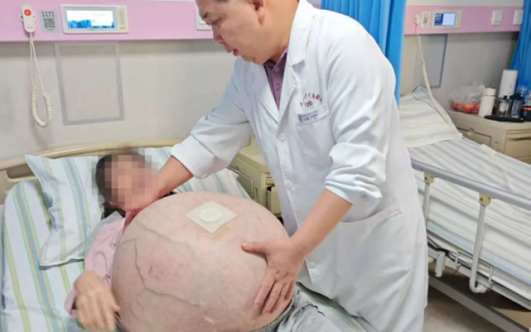 河北一女子肚子长80斤罕见巨瘤：血管暴突如蛛网 4小时切下