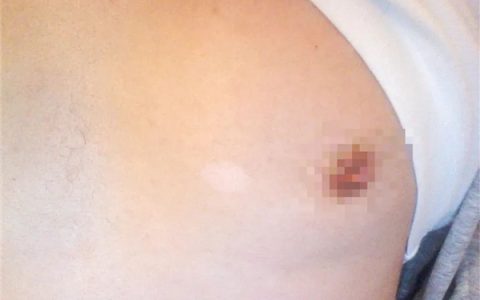 身上突然白了一块 到底是怎么回事