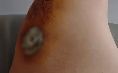 女子伤口似发霉听网友劝连夜就医 属凝血过程中正常现象