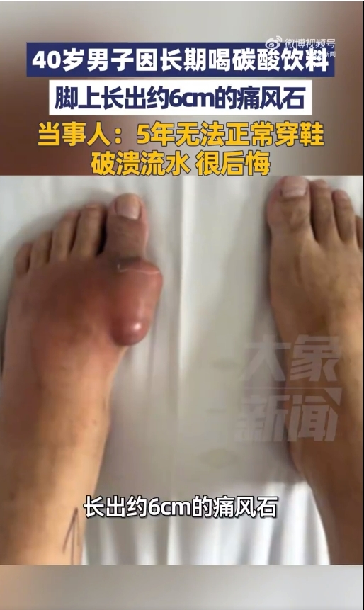 40岁男子因长期喝碳酸饮料 脚上长6cm痛风石 5年无法正常穿鞋