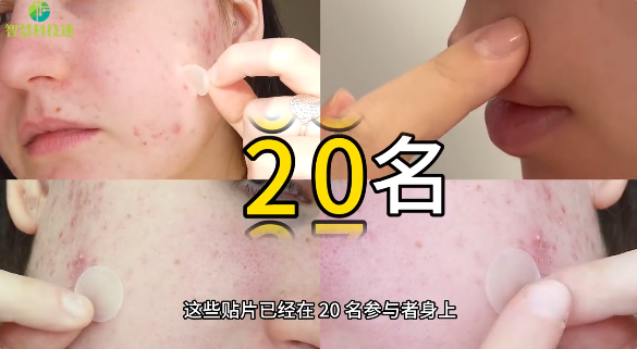 韩国开发出一种智能贴片：3D打印形成 7天内可消除青春痘