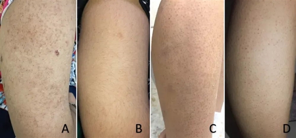 快住手！皮肤上的这些小颗粒真不是痘痘：别抠 也别随便用药