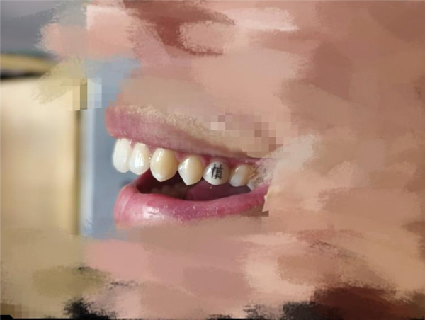 “发财”“上岸”刻牙上 牙齿上刻字成新玄学！专家：不建议