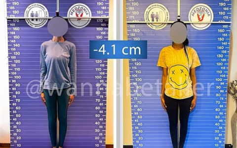 太疯狂！嫌个子太高不好找对象 女子手术切骨变矮