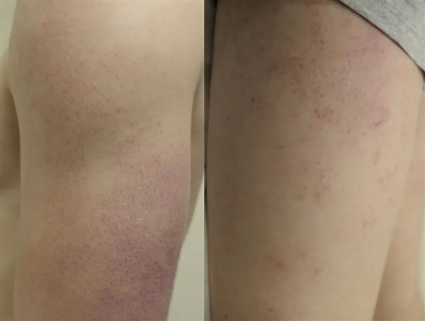 快住手！皮肤上的这些小颗粒真不是痘痘：别抠 也别随便用药