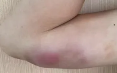 13岁男孩手臂长瘤确诊猫抓病 医生：或因其常喂流浪猫