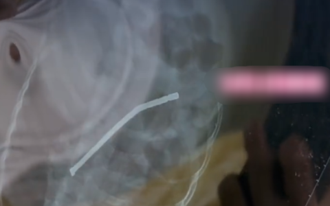 3岁娃吞下40多颗磁力珠致胃穿孔 奶奶以为能自行排出