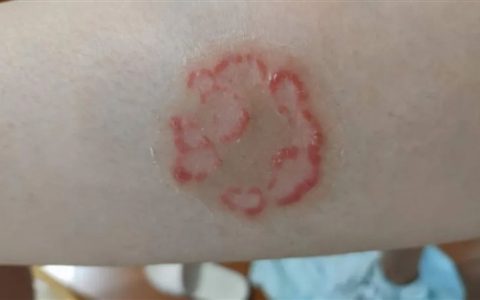 与银屑病斗争16年 我曾以为这辈子都找不到对象