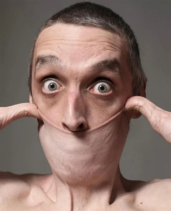世界上皮肤最有“弹性”的男子 看完可能整个人都不好了