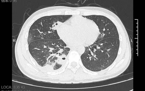 20岁男生挤了颗脸上的痘：肺被啃出10多个洞！