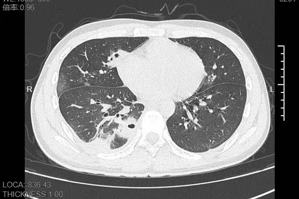 20岁男生挤了颗脸上的痘：肺被啃出10多个洞！
