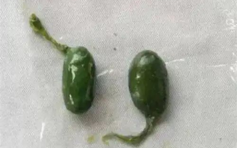 女子生吞鱼胆降火导致肝衰竭 医生：毒性堪比砒霜 无解药