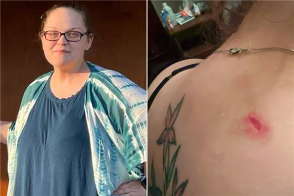 子弹卡在脂肪层 美国女子遇歹徒连中7枪奇迹生还！