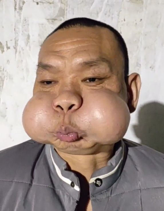 男子工厂吹玻璃30年肌肉拉伤严重：腮帮肿大成“青蛙王子”