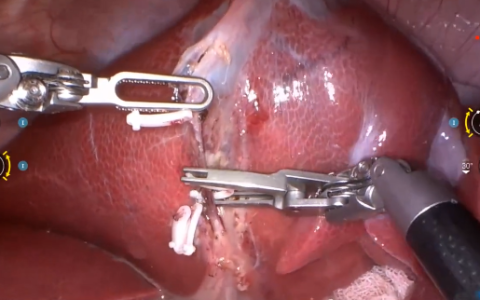 多重突破！微创机器人完成全球首例“大模型自主手术”动物实验