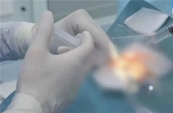38岁女子宅家熬夜刷手机 眼压飙升诱发青光眼险失明