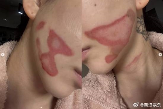 烧的太惨烈！韩国女星做医美竟然导致面度灼伤