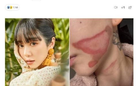 烧的太惨烈！韩国女星做医美竟然导致面度灼伤