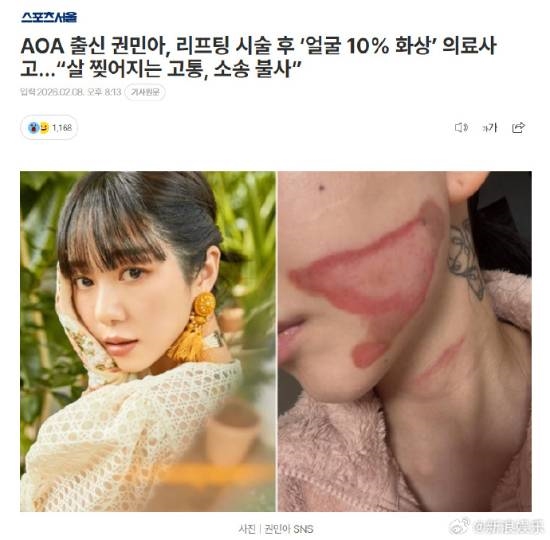 烧的太惨烈！韩国女星做医美竟然导致面度灼伤