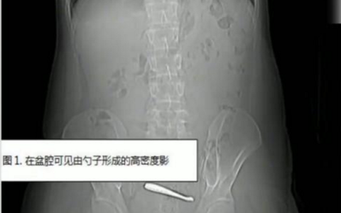 瞠目结舌：南京一小伙腹痛CT查出肠道卡2把勺子 直言吞下时没察觉