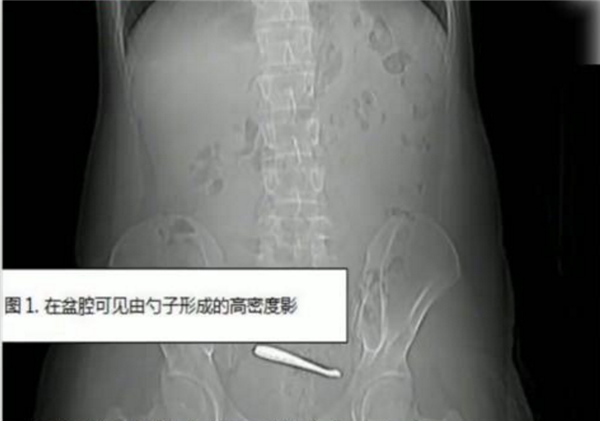 瞠目结舌：南京一小伙腹痛CT查出肠道卡2把勺子 直言吞下时没察觉