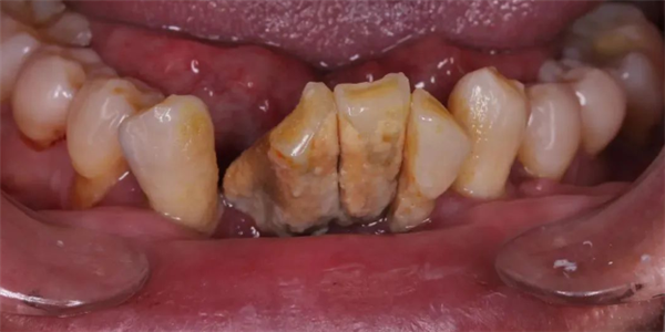 一种会让牙齿掉光的病 很多人年轻时不重视