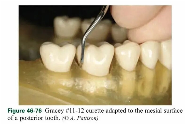 一种会让牙齿掉光的病 很多人年轻时不重视