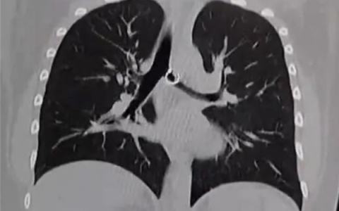 女子咳嗽一个月肺里惊现丢失鼻环 距离死亡仅剩0.5mm！