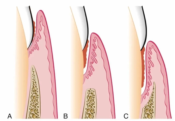一种会让牙齿掉光的病 很多人年轻时不重视