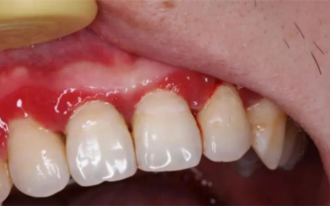 一种会让牙齿掉光的病 很多人年轻时不重视