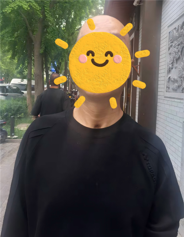 一男子不戴头盔骑电摩与汽车相撞：致颅骨碎成17块